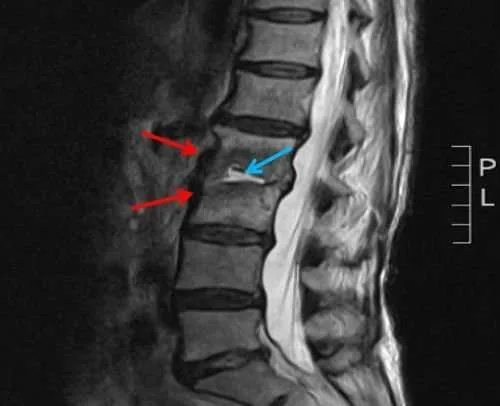 Disco-intervertebrale-RX