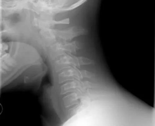 Corso riequilibrio posturale Rachide Cervicale